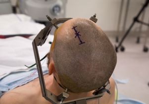 Deep brain stimulation - preparation