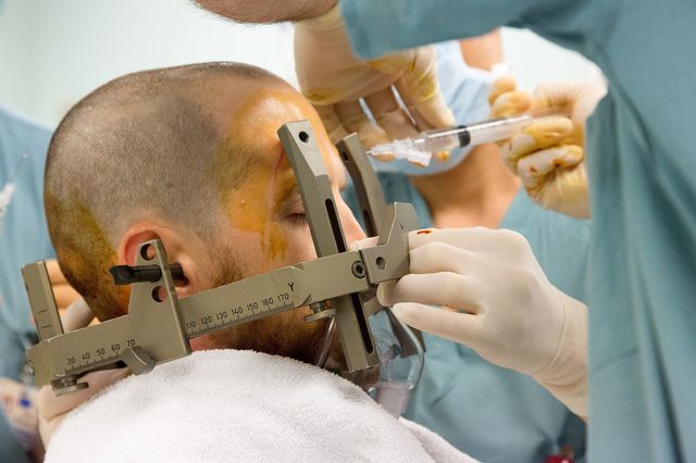 Deep brain stimulation preparation