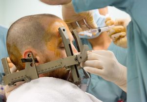 Deep brain stimulation preparation