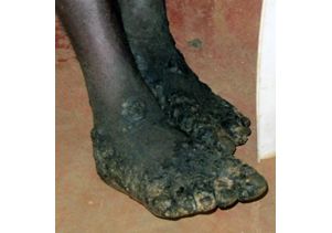 Foot infected with chiggers