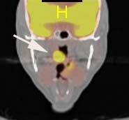 HPV Cancer with arrow