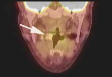 Post Treatment with arrow