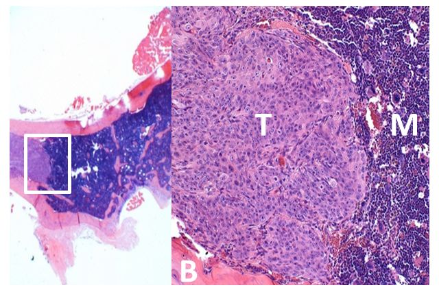Prostate cancer metastasis in bone