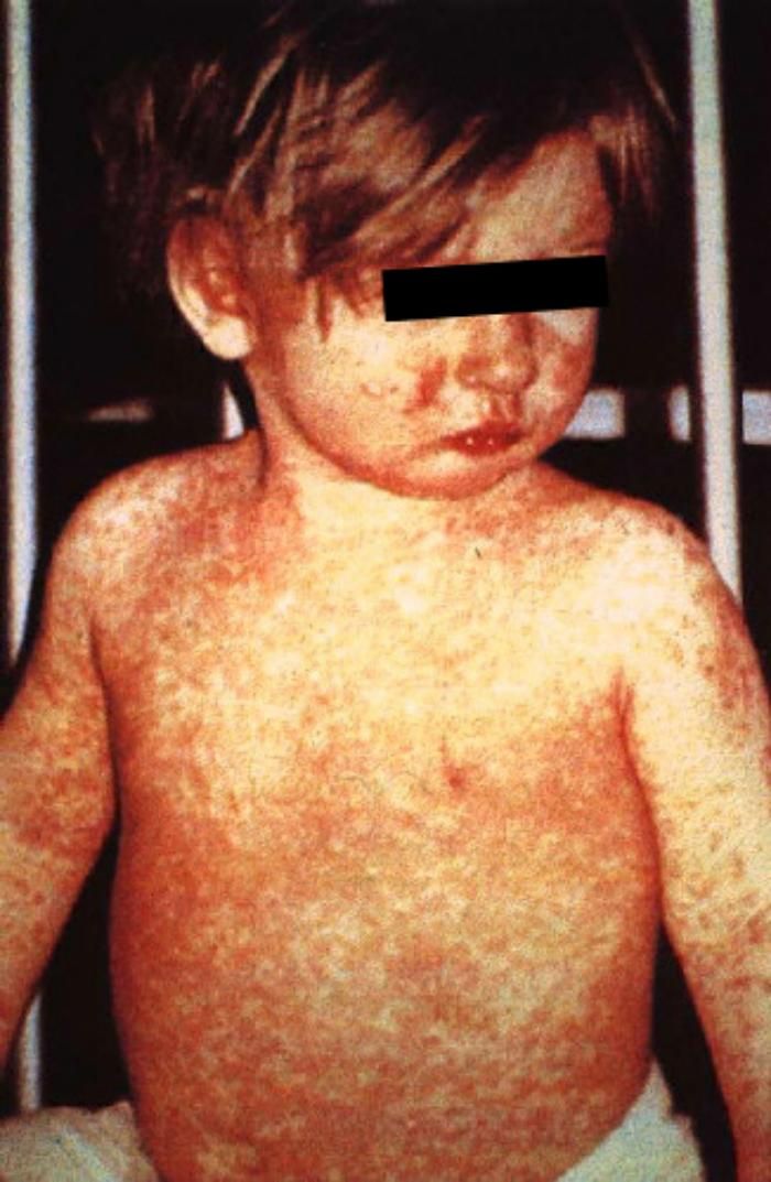 A child with measles