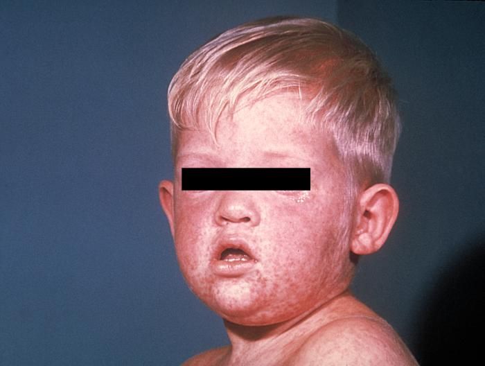 Face of a boy with measles