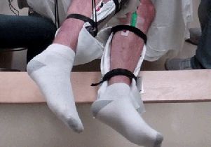 Legs before and after