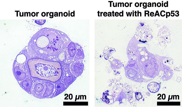 Tumor cells