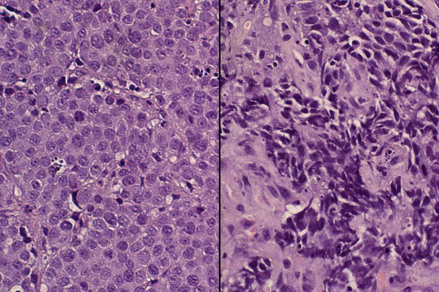 Prostate cancer cells