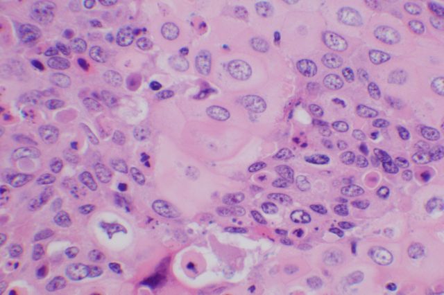 Cervical cancer cells