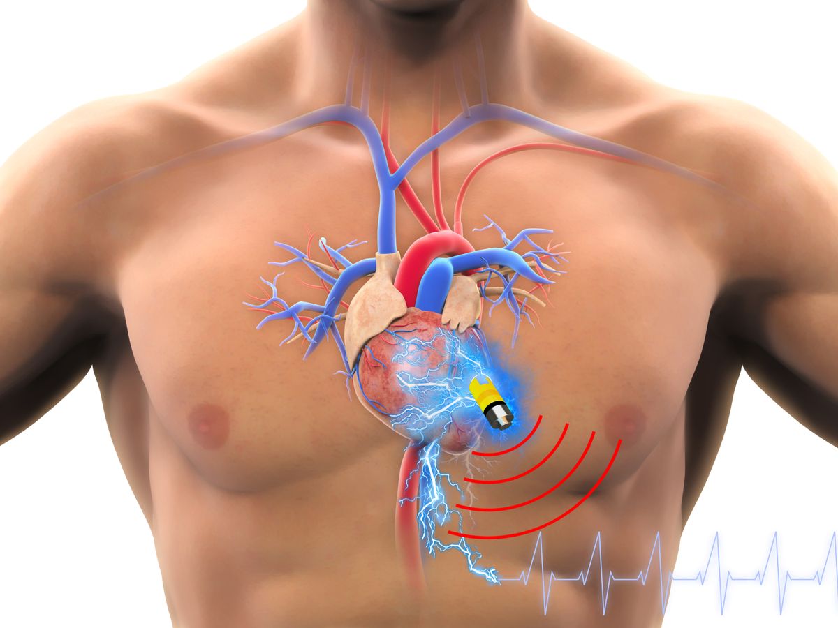 Biosupercapacitor in pacemaker