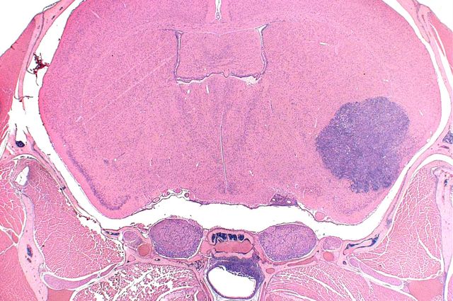 Mouse brain rhabdoid tumor