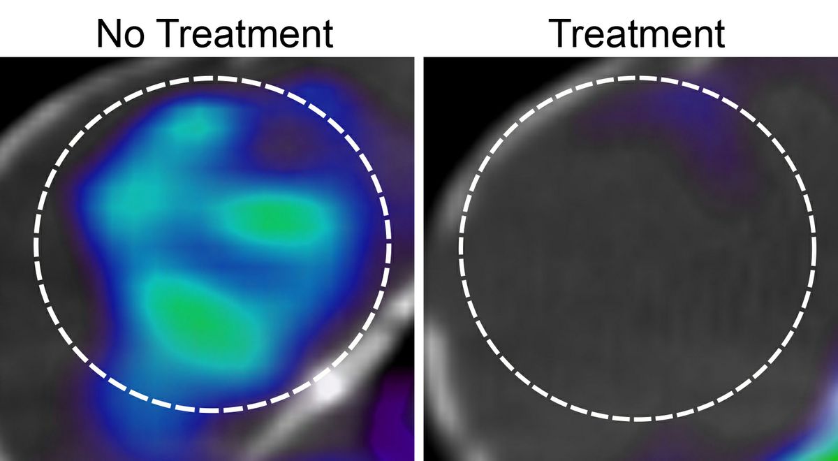 Before and after treatment of glioblastoma