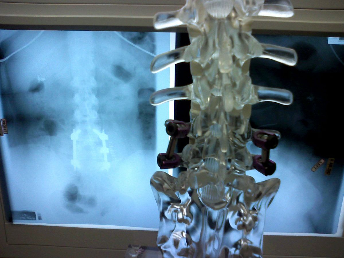 Spinal surgery
