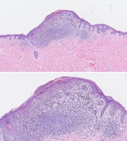 Melanoma in situ