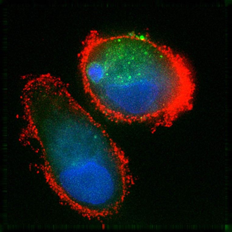 Dendritic cell with tumor cell materials