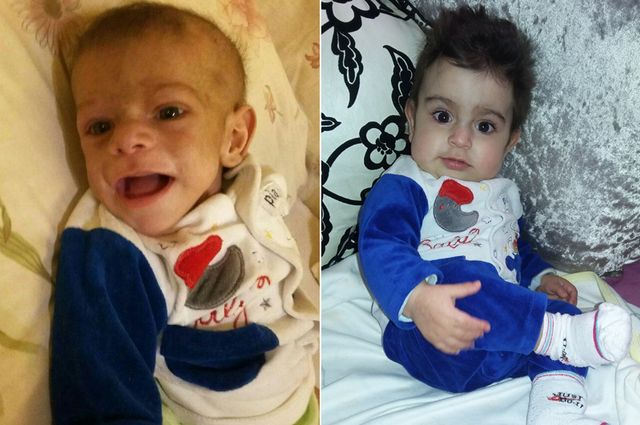 Hussein before and after procedure