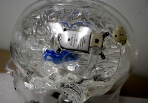 Epilepsy: RNS device 