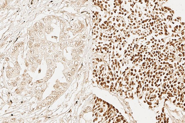 Adult stem cell signature marker in lung cancer cells