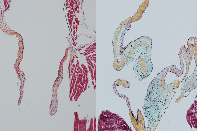 Heart valve comparison