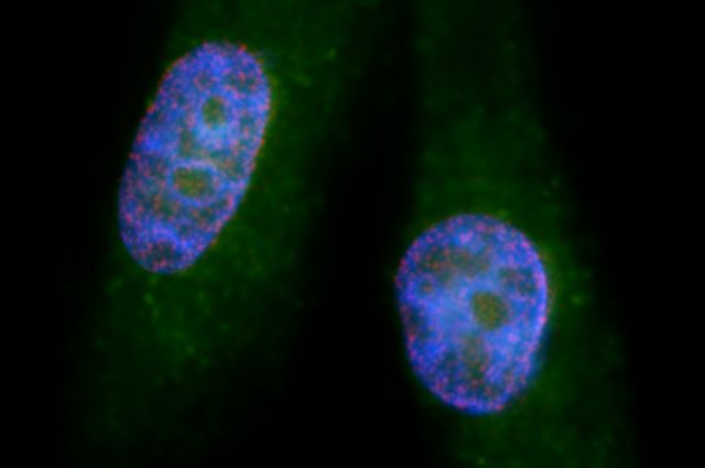 cancer cells-pancreatic