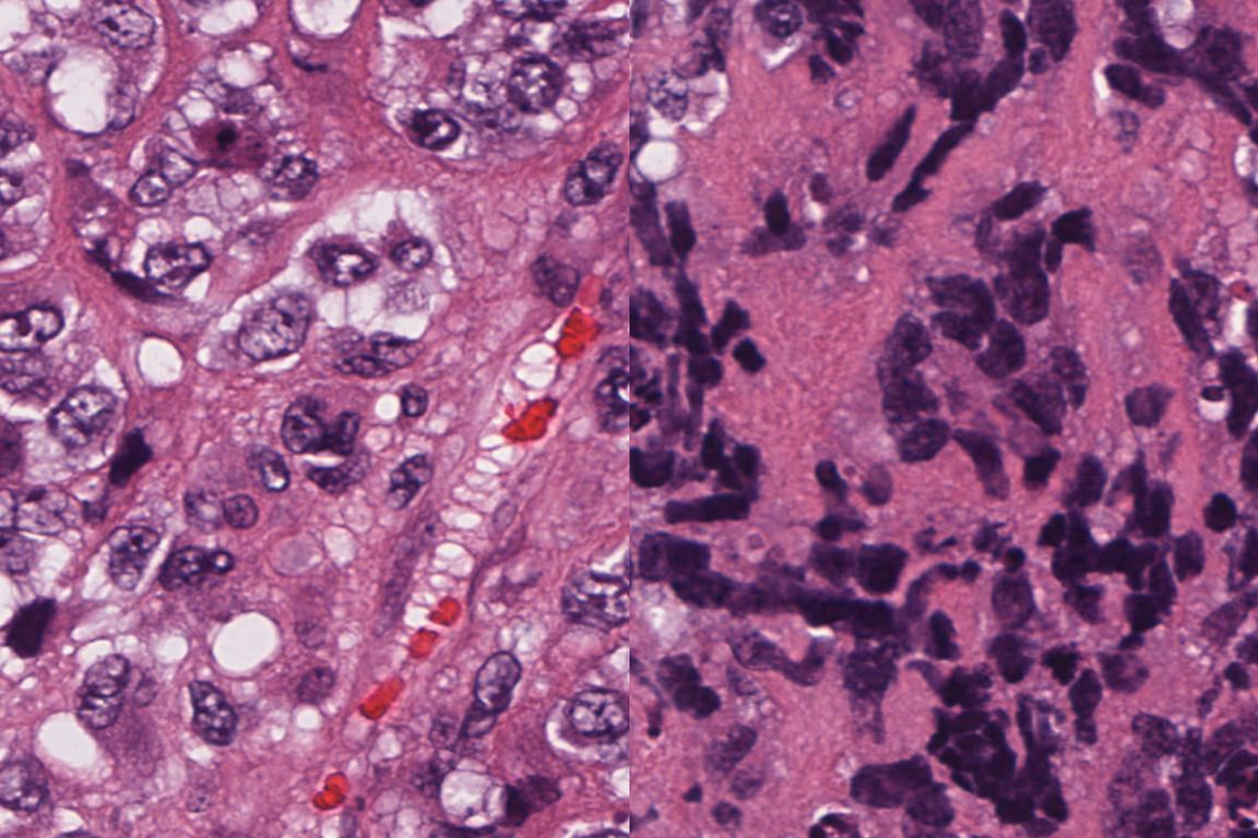 Non small cell and small cell cancers 