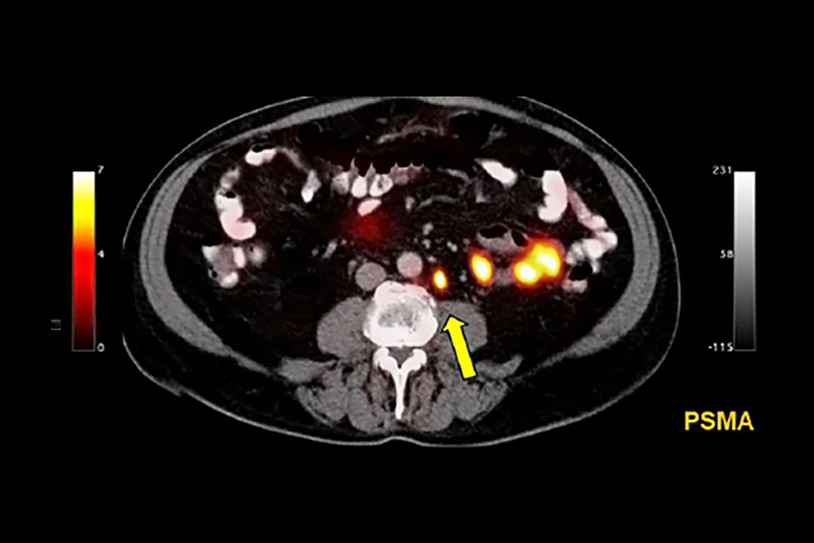 Prostate cancer imaging scan