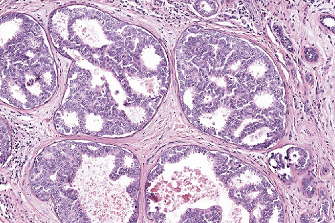 DCIS from Elmore Lab