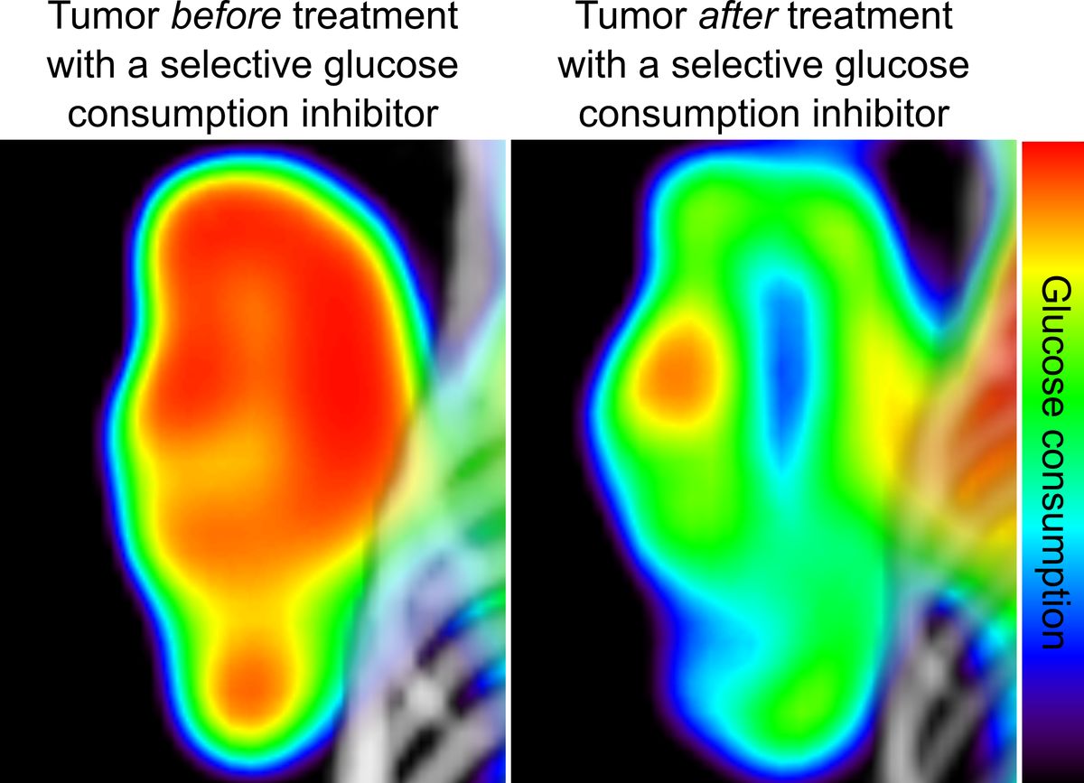 Cancer metabolism