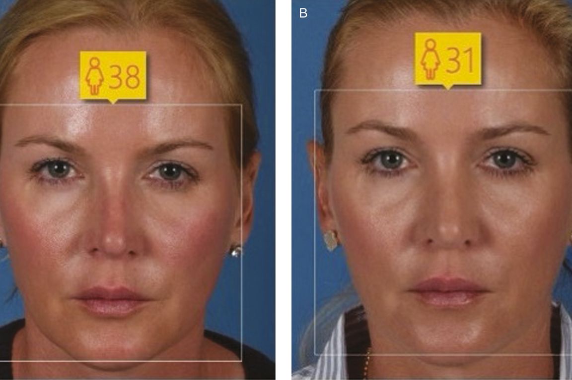 woman-rhinoplasty