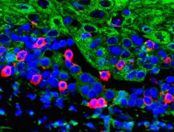 T cells and tumor tissues