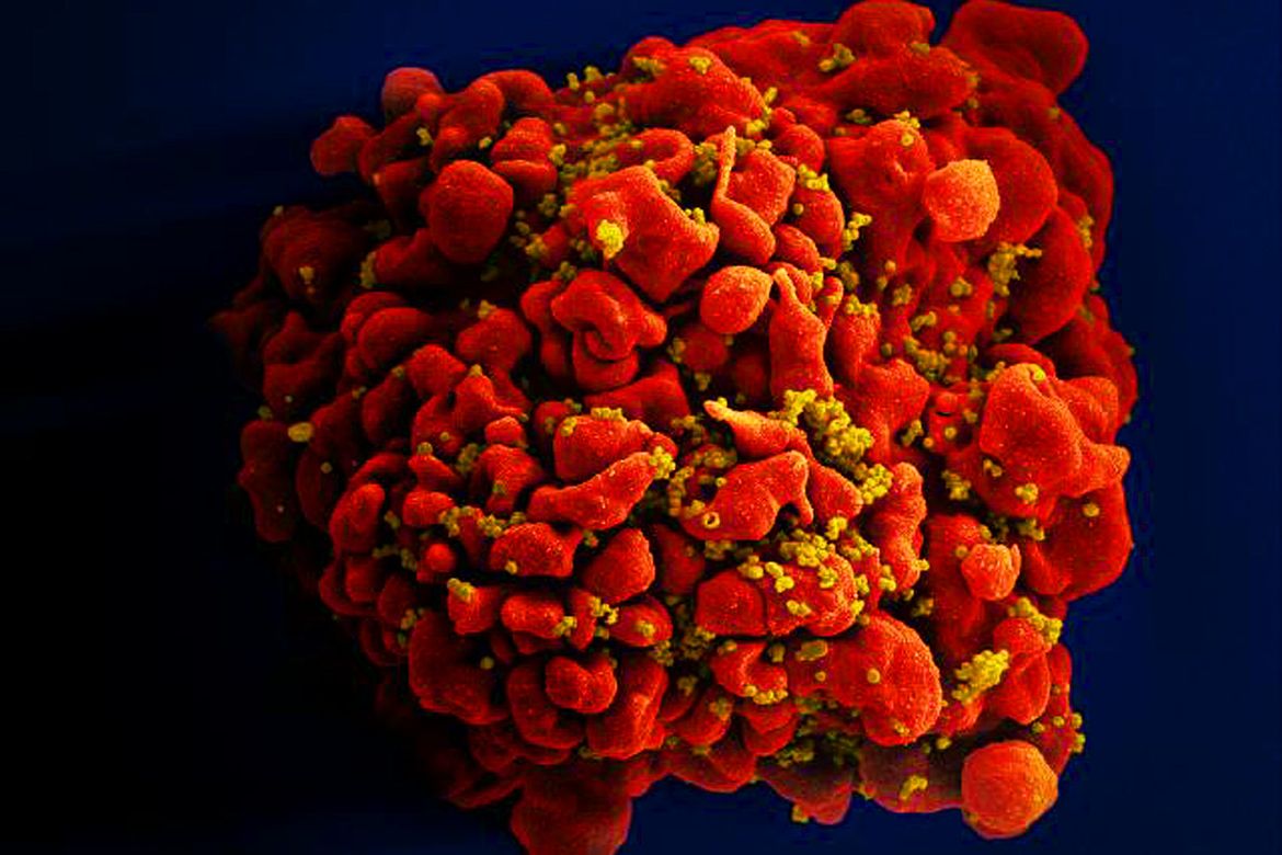 T cell infected with HIV