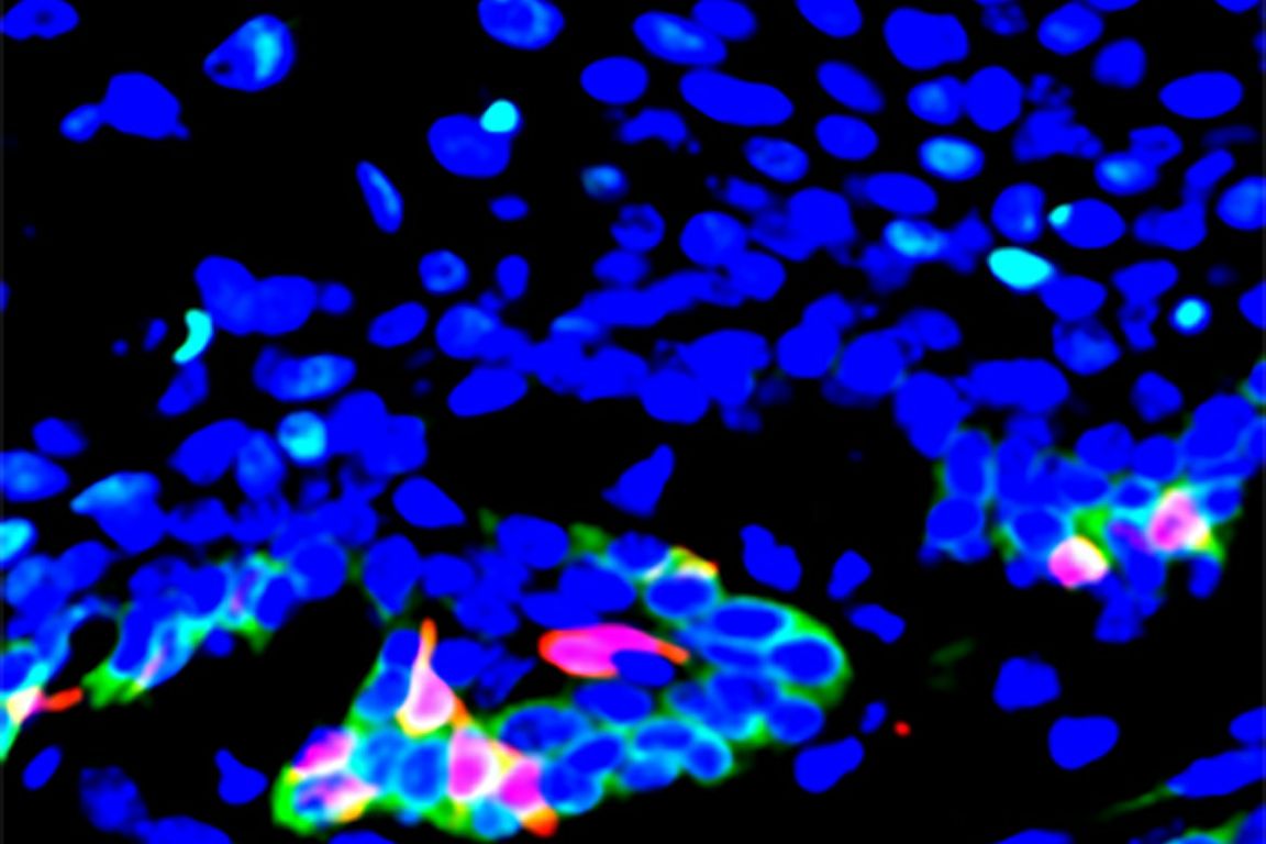 UCLA team discovers how to restrict growth, spread of head and neck cancers - Vimarsana News