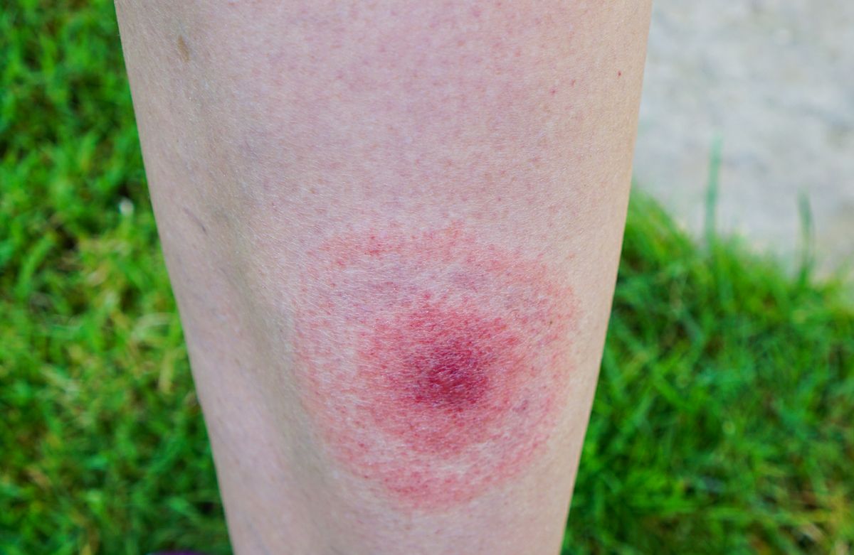Lime Disease Rash 2