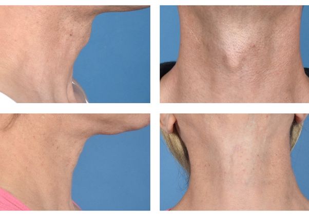 Adams apple surgery before and after