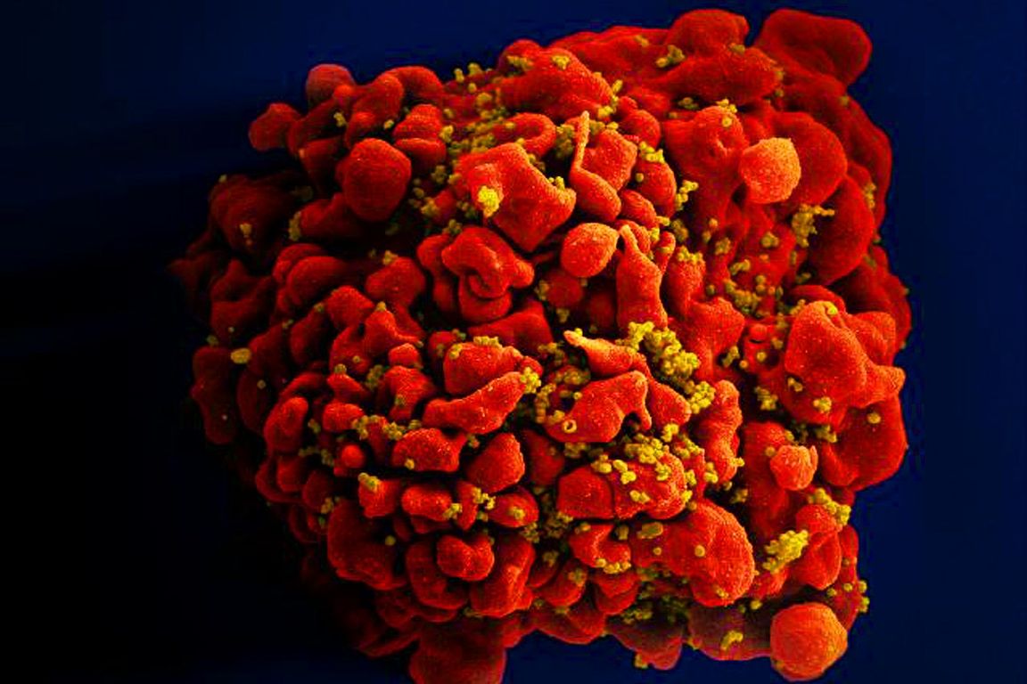 A T cell infected with HIV