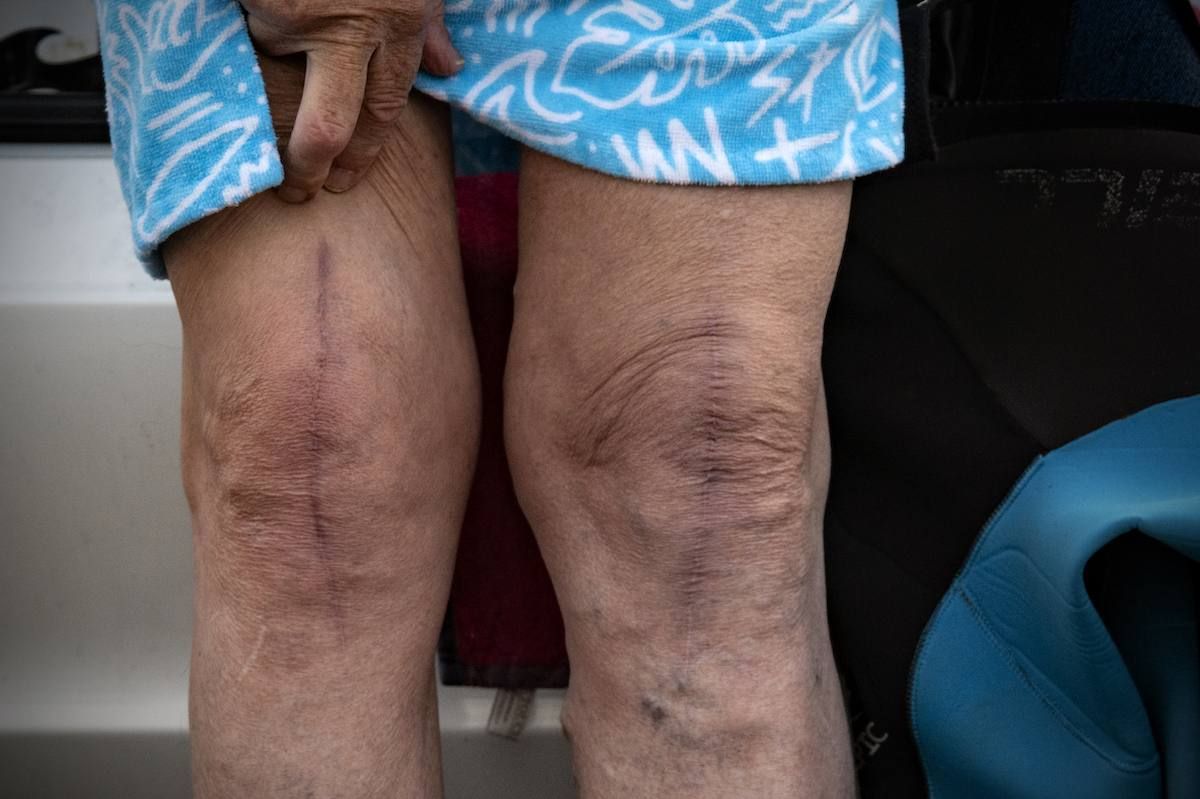 Robert Lombard’s knees, with scars from surgery.
