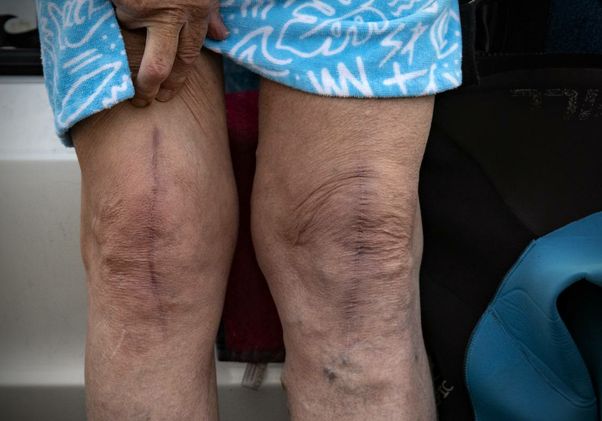 Robert Lombard’s knees, with scars from surgery.