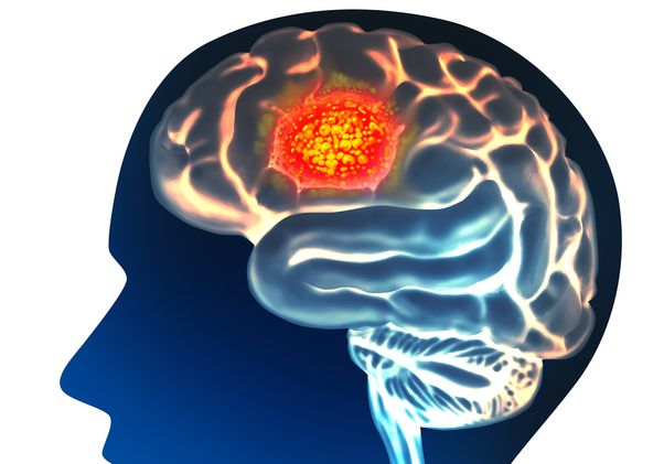 Brain cancer anatomy illustration