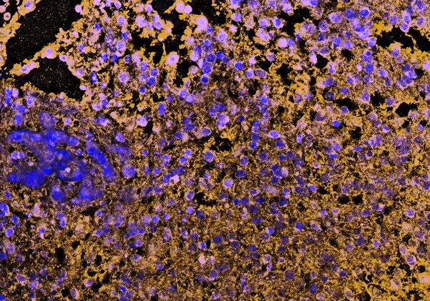 CDKN2A-deleted glioblastoma tumor 