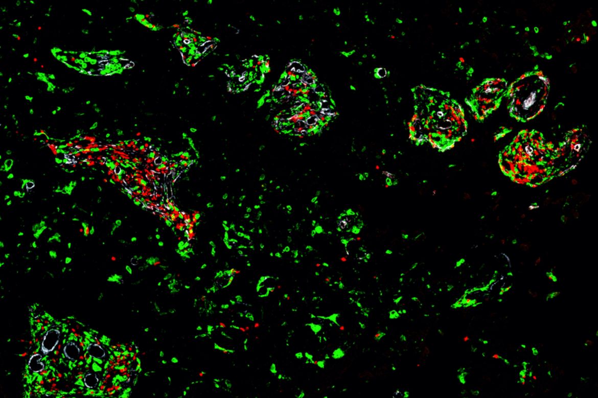 T cells blocked from reaching brain tumor