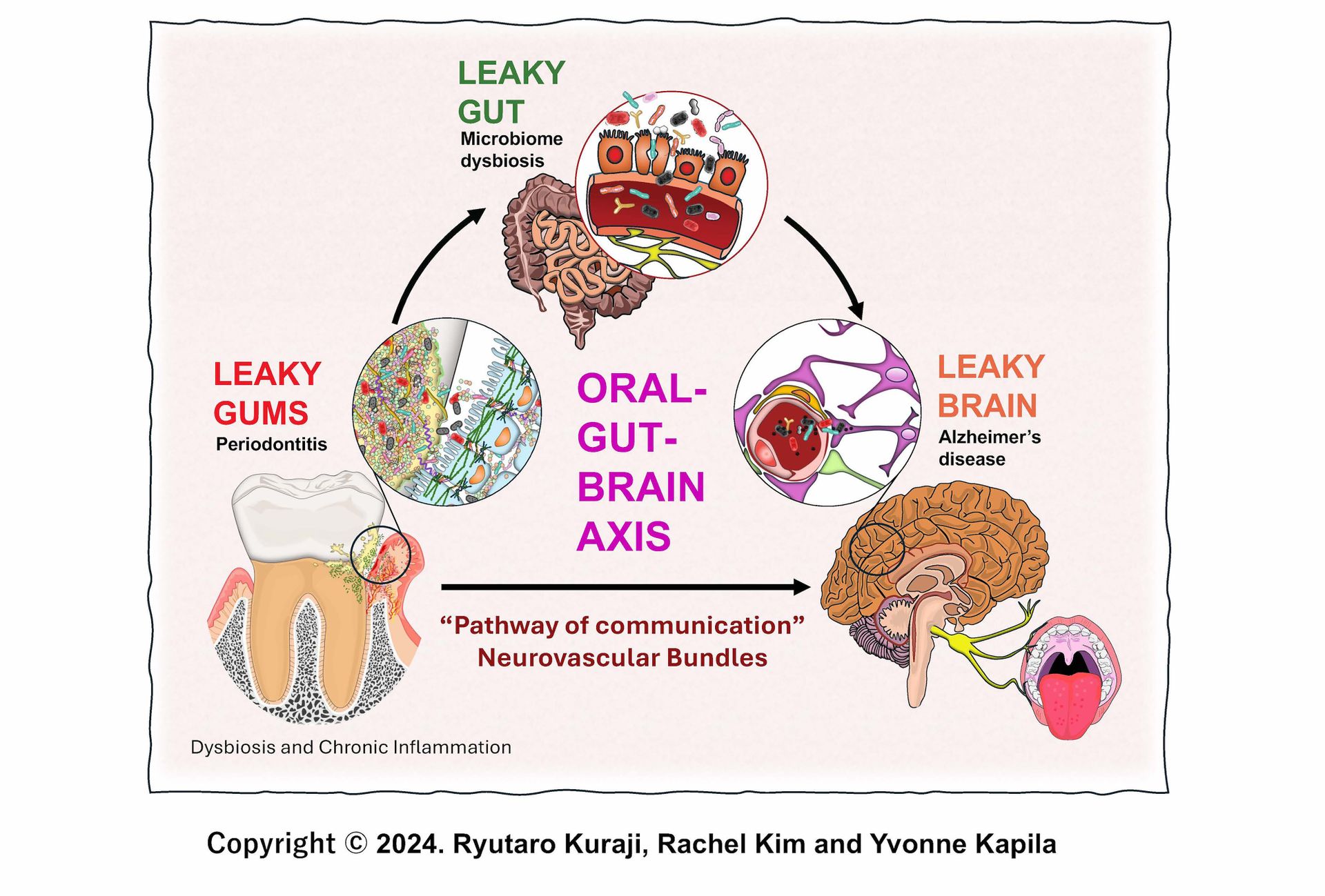 leaky oral gut brain-hvcc