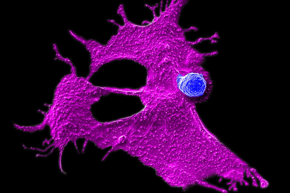 A colorized scanning electron microscopy image showing a CAR-NKT immune cell (shown in blue) attacking a tumor cell (shown in magenta) against a black background.