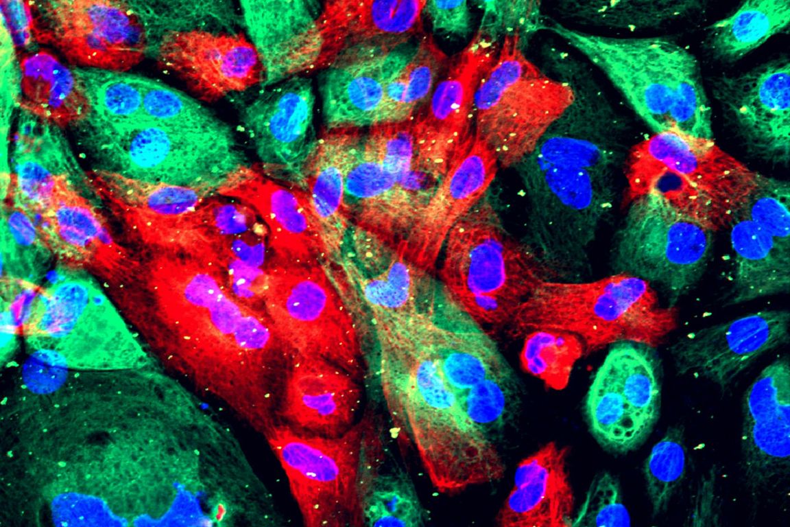 prostatecancermodel