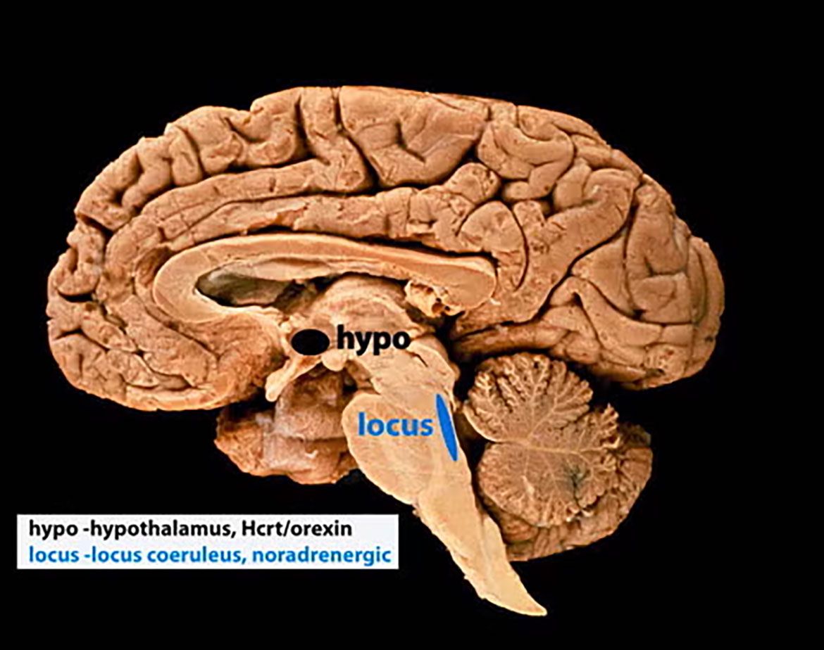 Cross section brain model with hypo and locus marked against back background