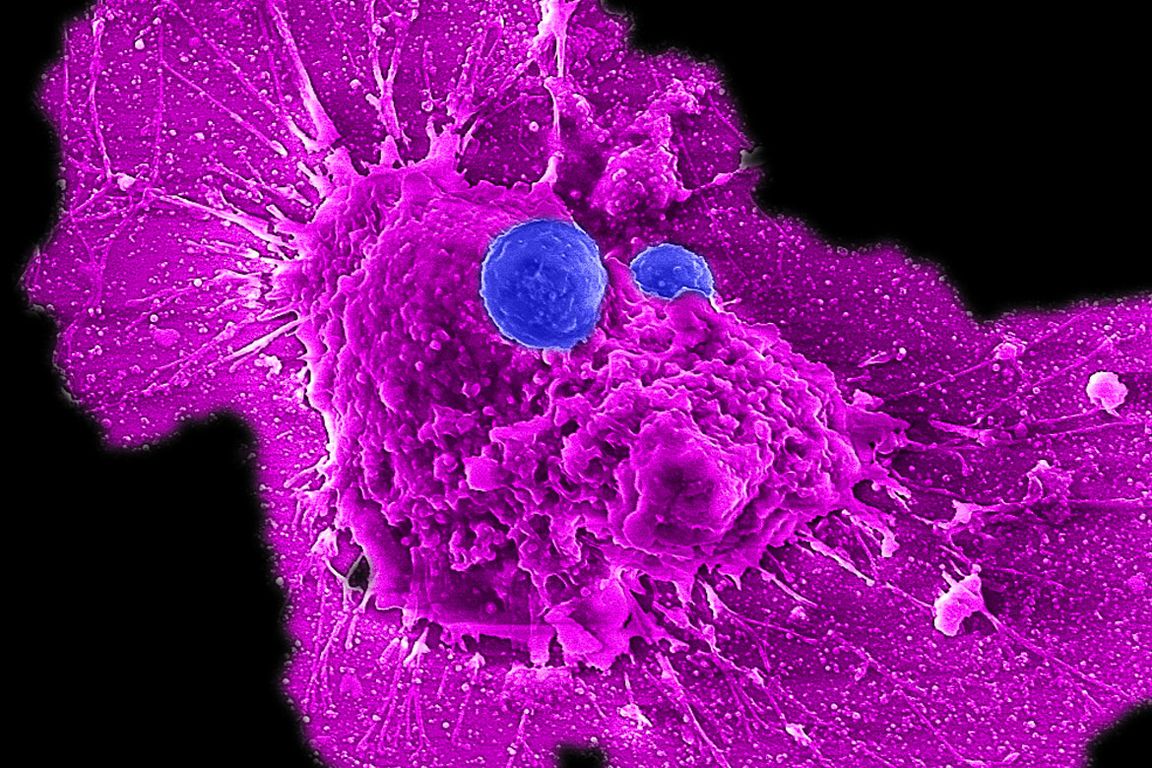 UCLA scientists develop off-the-shelf immunotherapy for ovarian cancer
