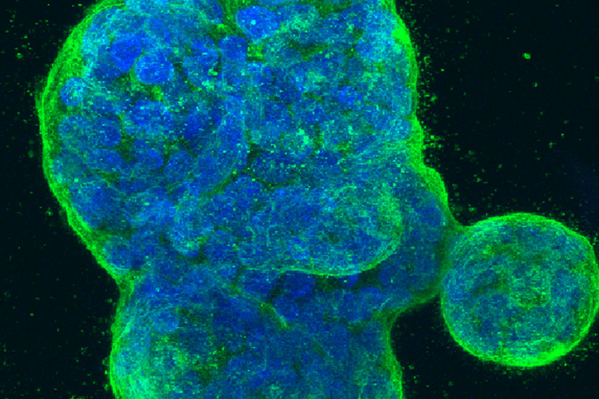 Three-dimensional culture of human breast cancer cells, with DNA stained blue and a protein in the cell surface membrane stained green. Three-dimensional culture of human breast cancer cells, with DNA stained blue and a protein in the cell surface membrane stained green.