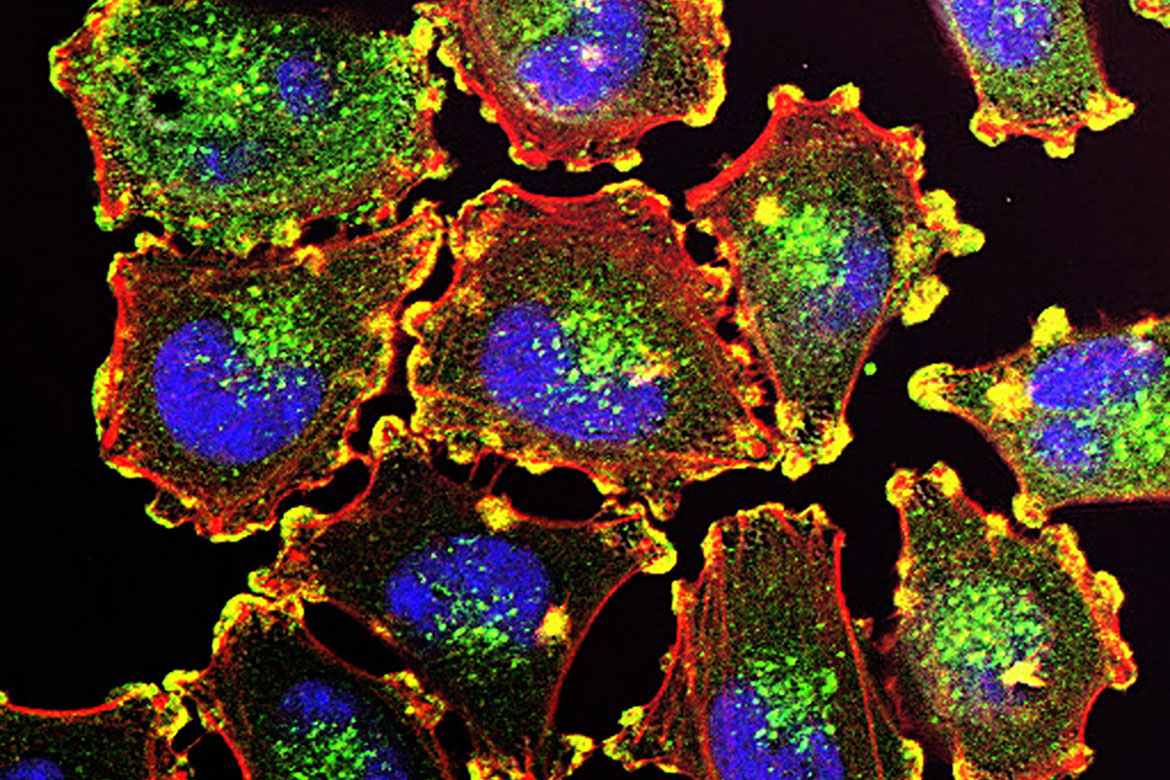 Metastatic melanoma cells. Metastatic melanoma cells.