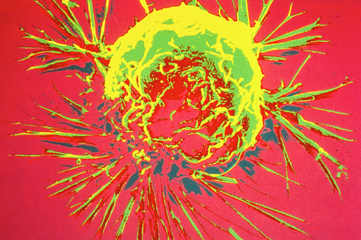 A breast cancer cell, photographed by a scanning electron microscope, which produces a 3-dimensional images. A breast cancer cell show in red, yellow and green.