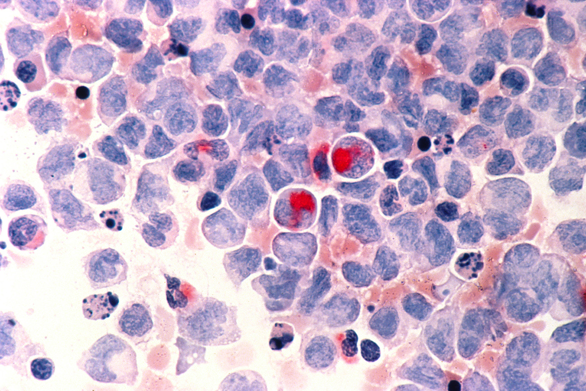 Human cells with acute myelocytic leukemia (AML) in the pericardial fluid, shown with an esterase stain at 400x. Human cells with acute myelocytic leukemia (AML) in the pericardial fluid, shown with an esterase stain at 400x.