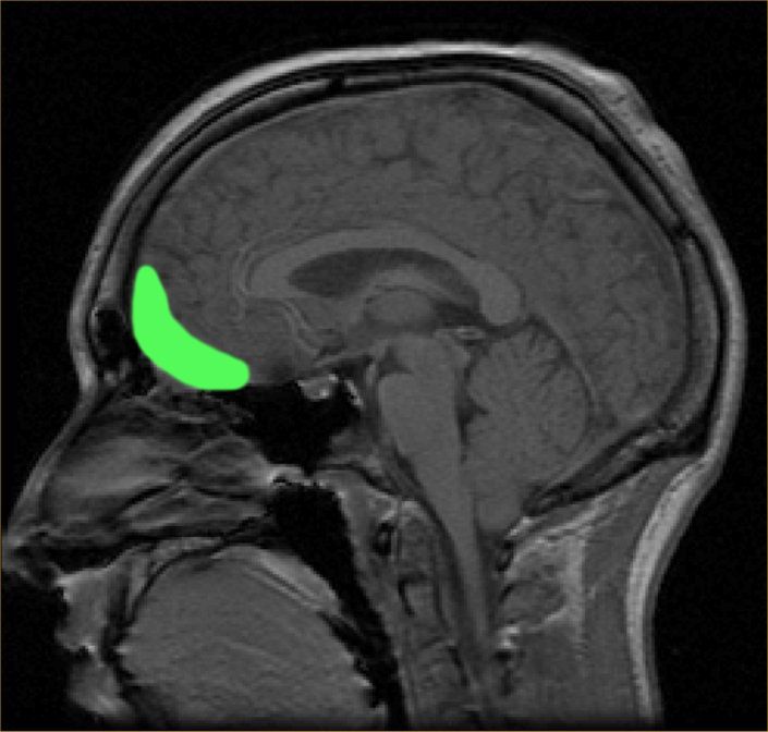 MRI showing orbitofrontal cortex highlighted in green